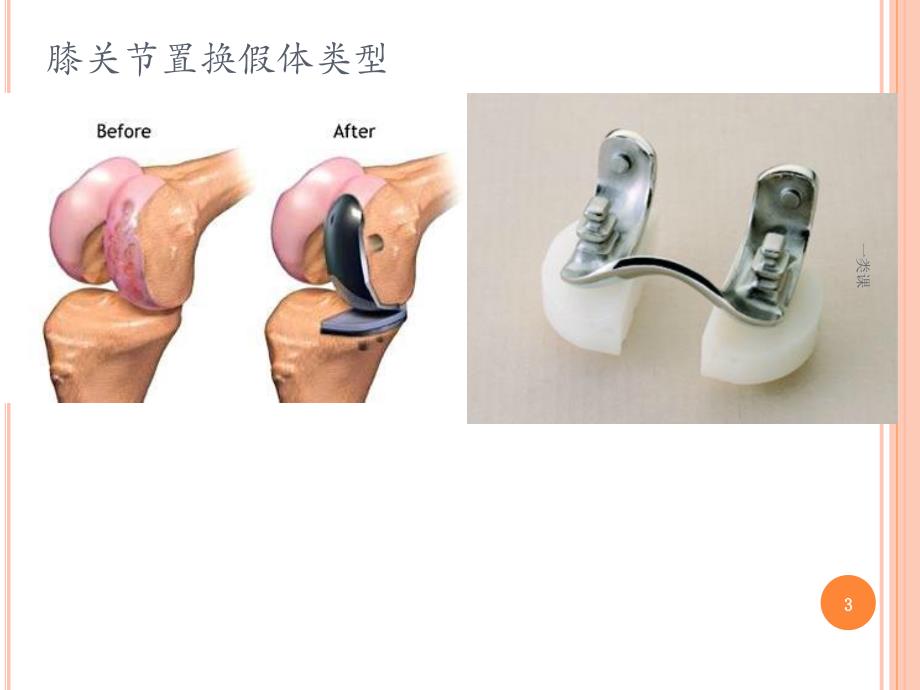 牛津单髁适应症【医疗研究】_第3页