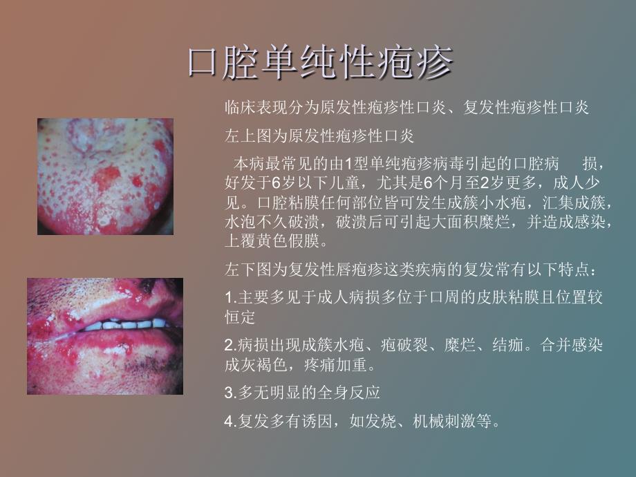 口腔粘膜感染性疾病_第2页