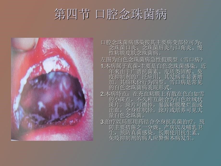 口腔粘膜感染性疾病_第5页