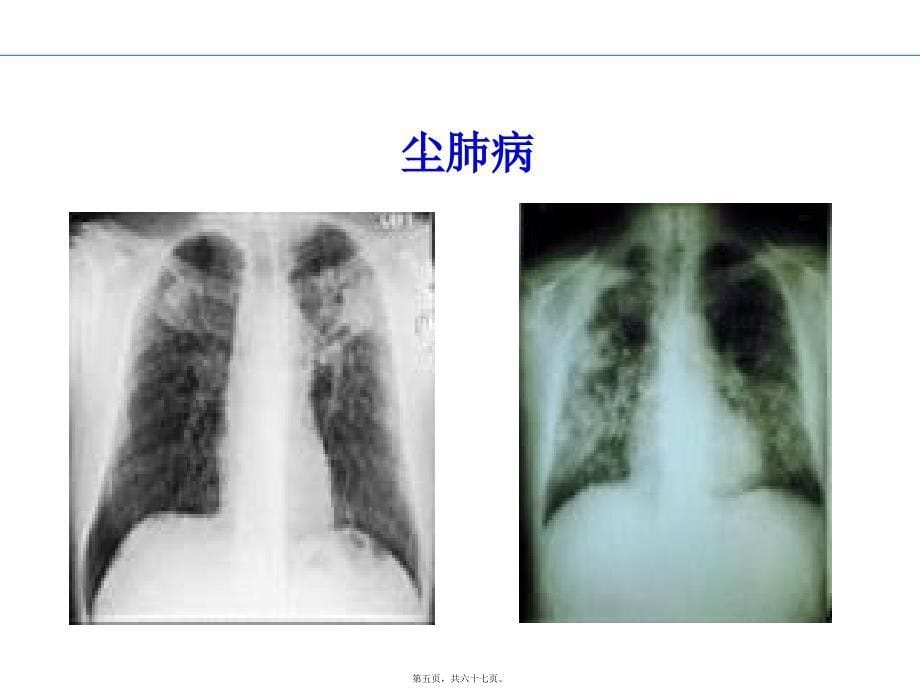 医学专题—新职业病防治法_第5页