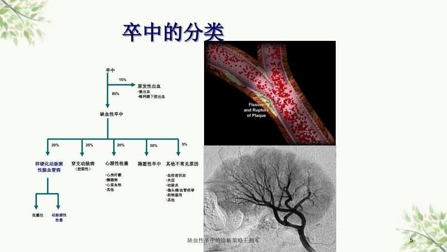 缺血性卒中的诊断策略王拥军课件_第5页