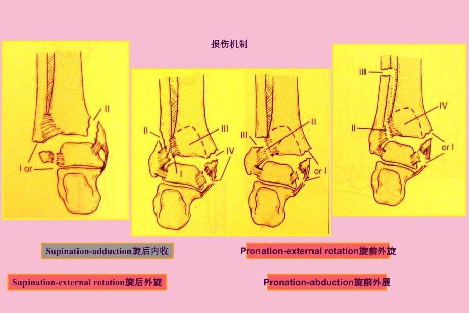 下胫腓联合损伤的诊治ppt课件_第5页