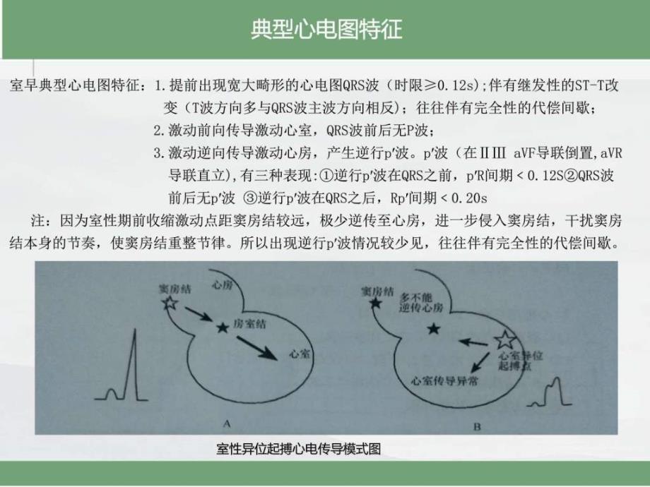 室性早搏的心电图诊断PPT_第4页