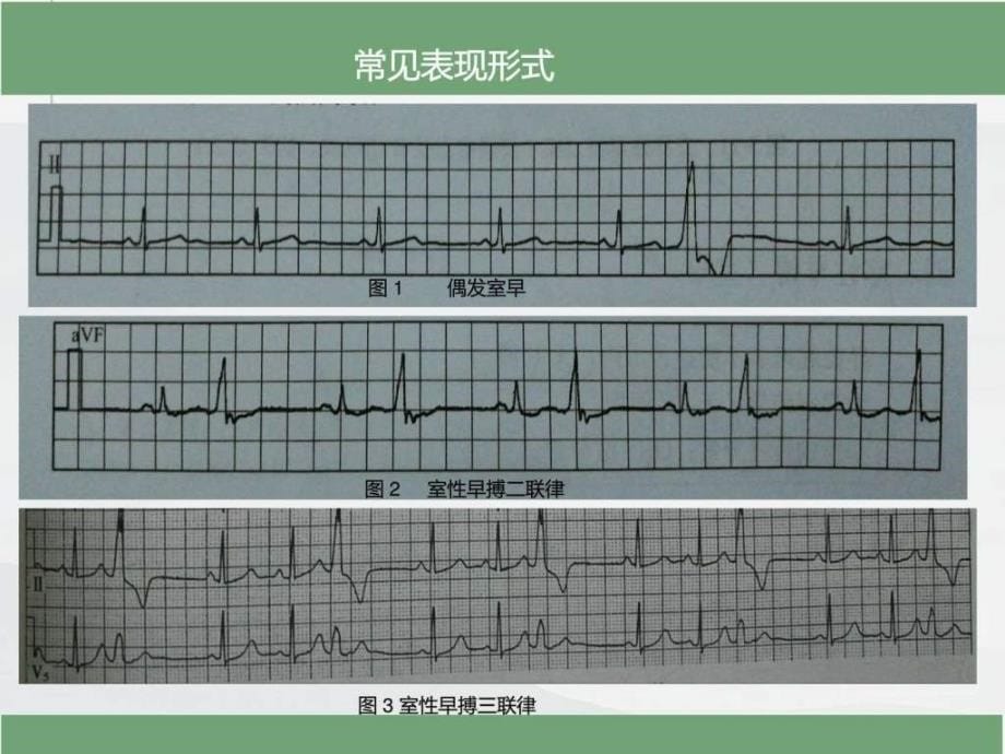 室性早搏的心电图诊断PPT_第5页