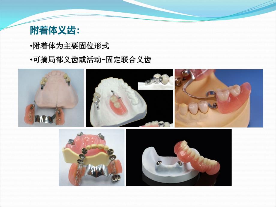 牙列缺损缺失固定活动义齿修复_第3页