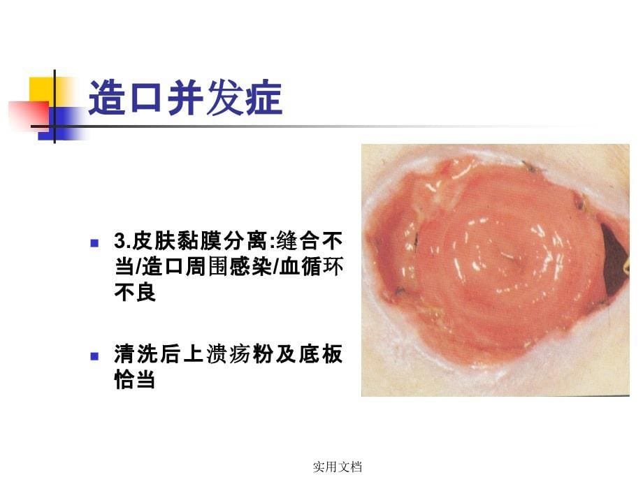 肠造口常见并发症及处理课件_第5页