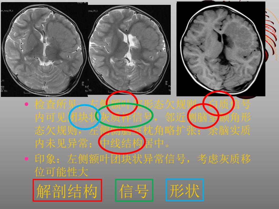 临床医学颅脑解剖及MRI基本征象_第2页