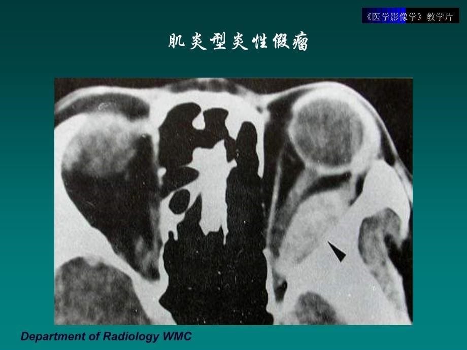 《医学影像学》实验课件（临床专业）：教学片13-五官头颈部_第5页