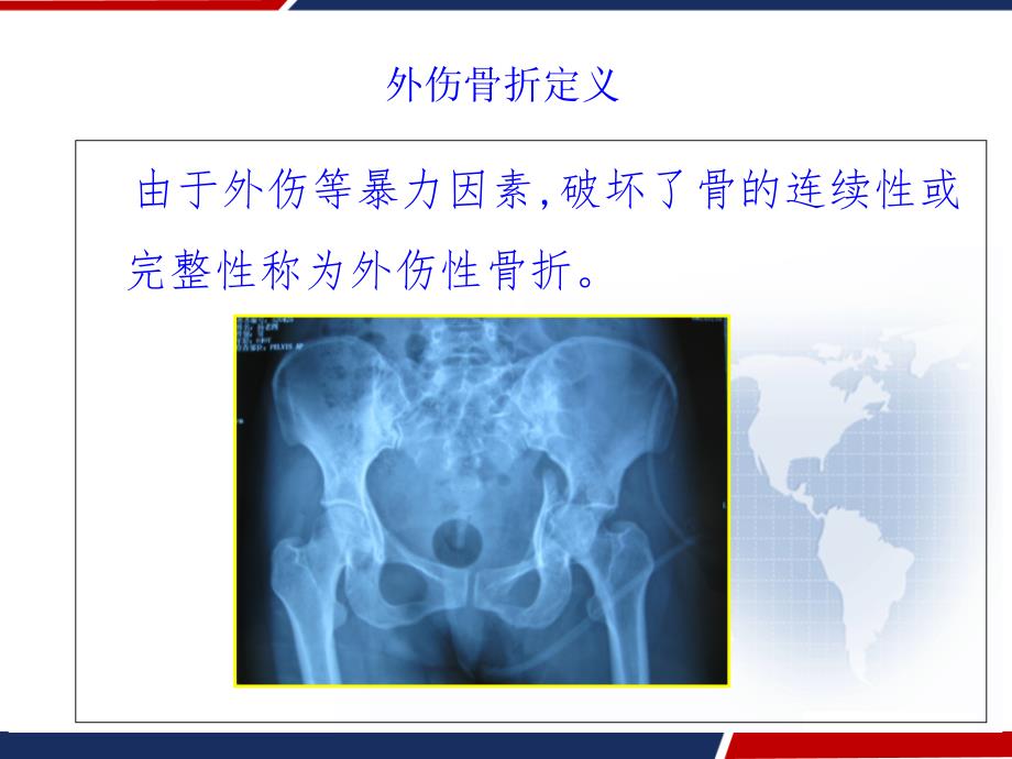 四肢骨折现场急救外固定技术-课件_第3页