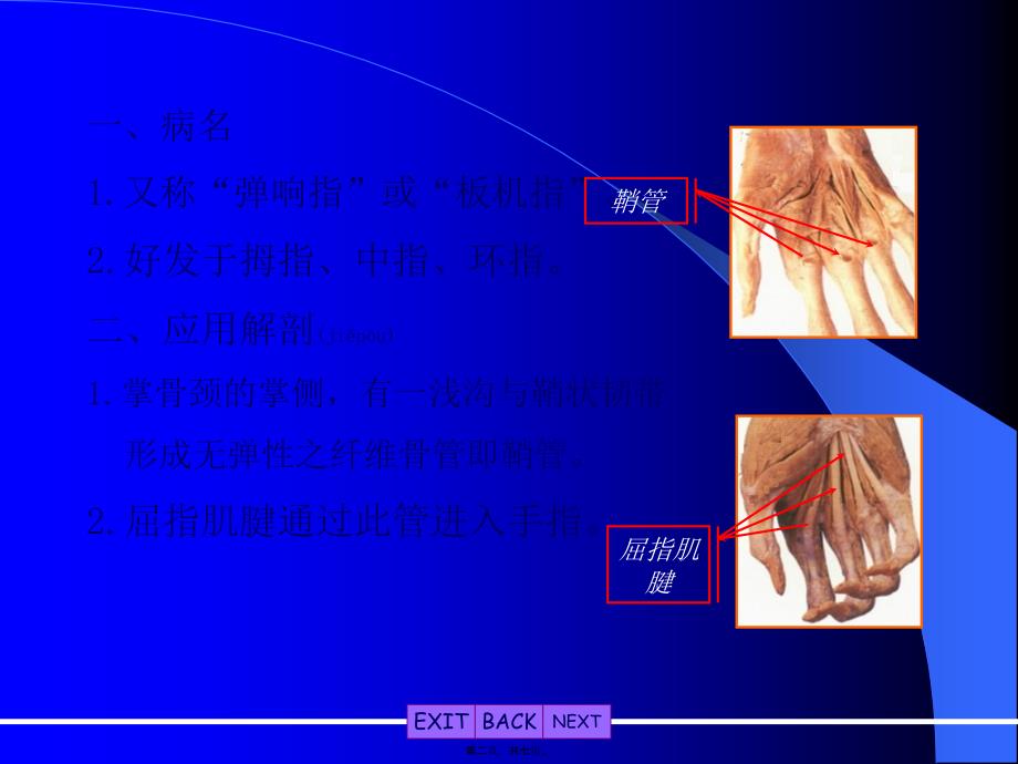 医学专题—屈指肌腱腱鞘炎_第2页