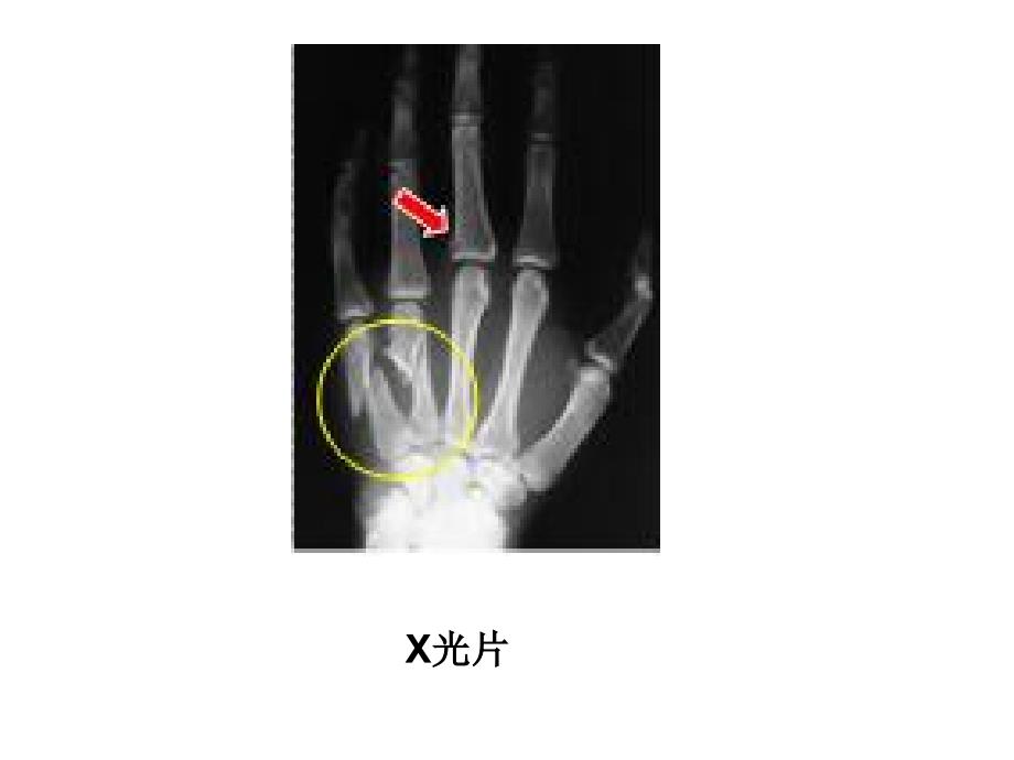 传统胆囊切除手术伤口腹腔镜胆囊切除手术伤口胆囊切除手术弯剪_第2页