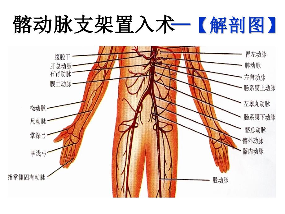 血管内支架置入术讲义课件_第4页