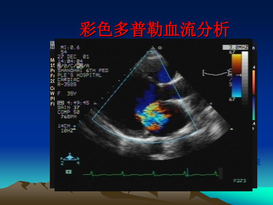 血管超声诊断49528.ppt_第3页