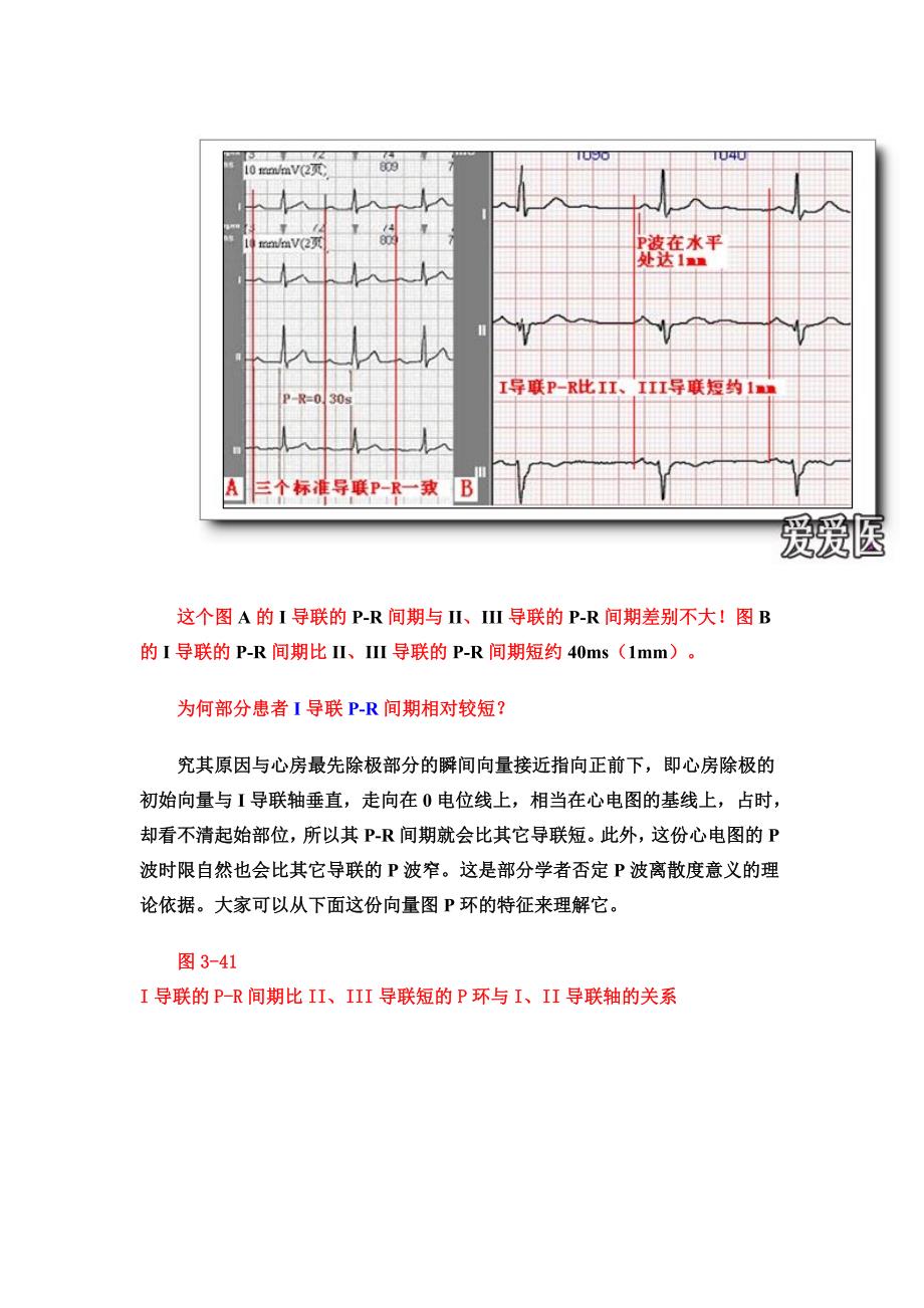 第六讲PR间期与PR段分析_第3页