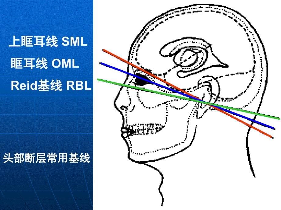 头颅CT基本知识与常见疾病_第5页