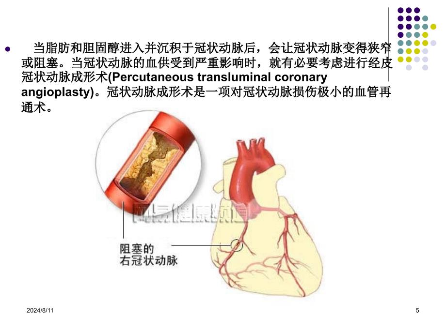 最新PCI术后常见并发症原因分析和对策主题讲座课件_第5页