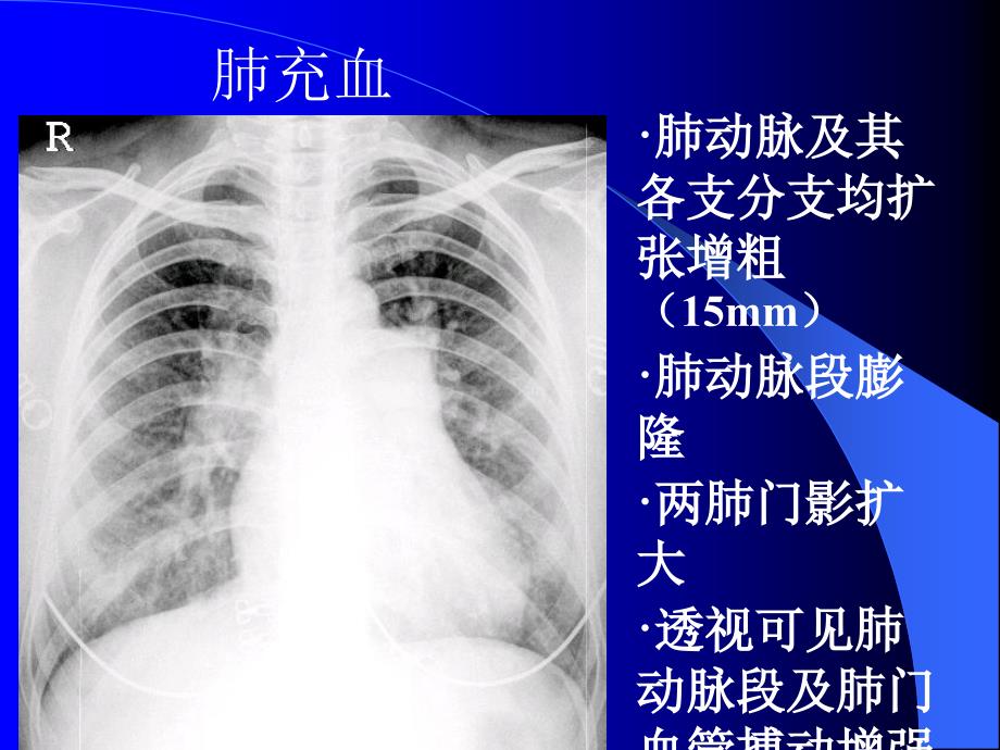 肺充血与肺淤血区别_第3页