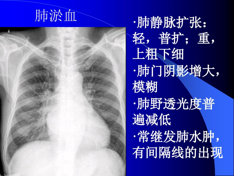 肺充血与肺淤血区别_第4页