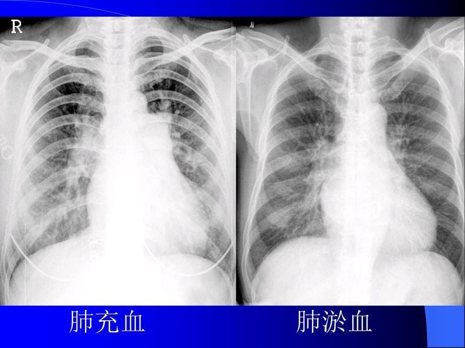 肺充血与肺淤血区别_第5页