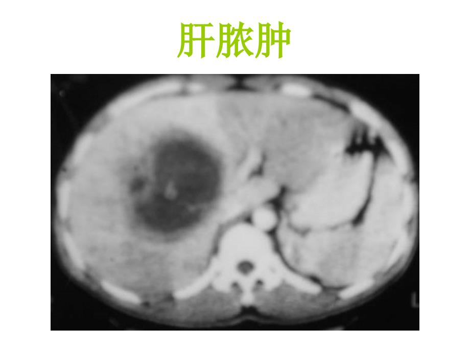 肝脏疾等病影像诊断2ppt课件_第1页