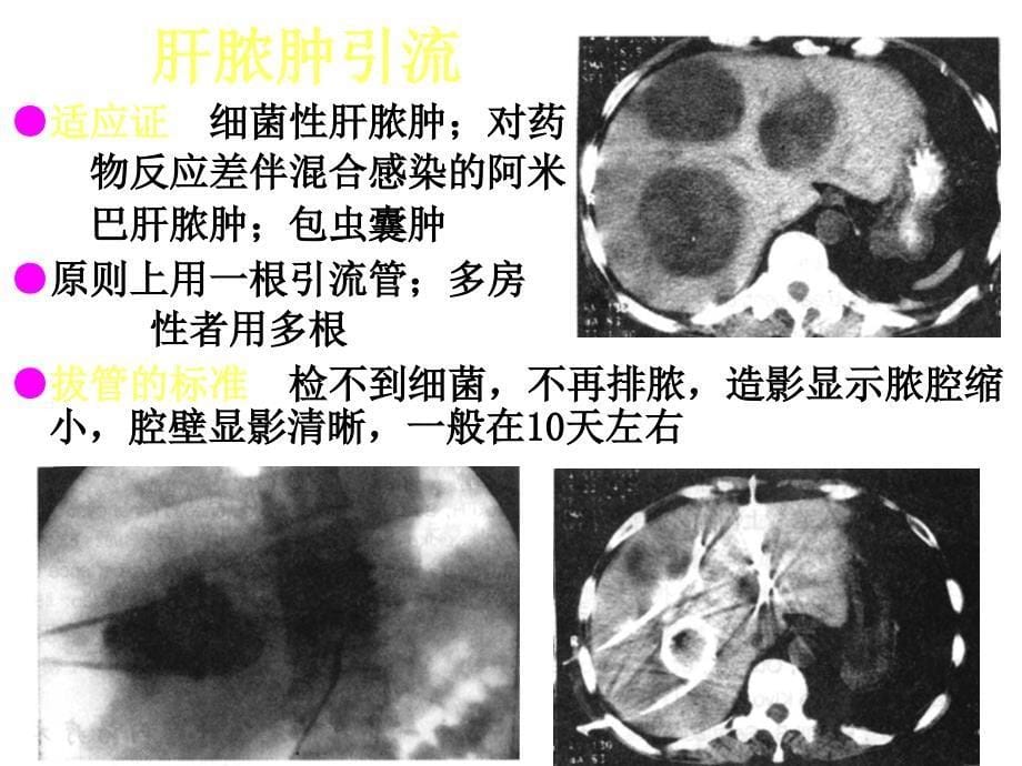 肝脏疾等病影像诊断2ppt课件_第5页