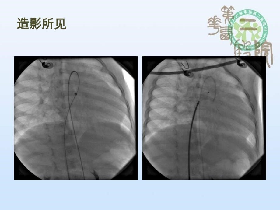 冠状动脉瘘介入治疗华益民_第5页