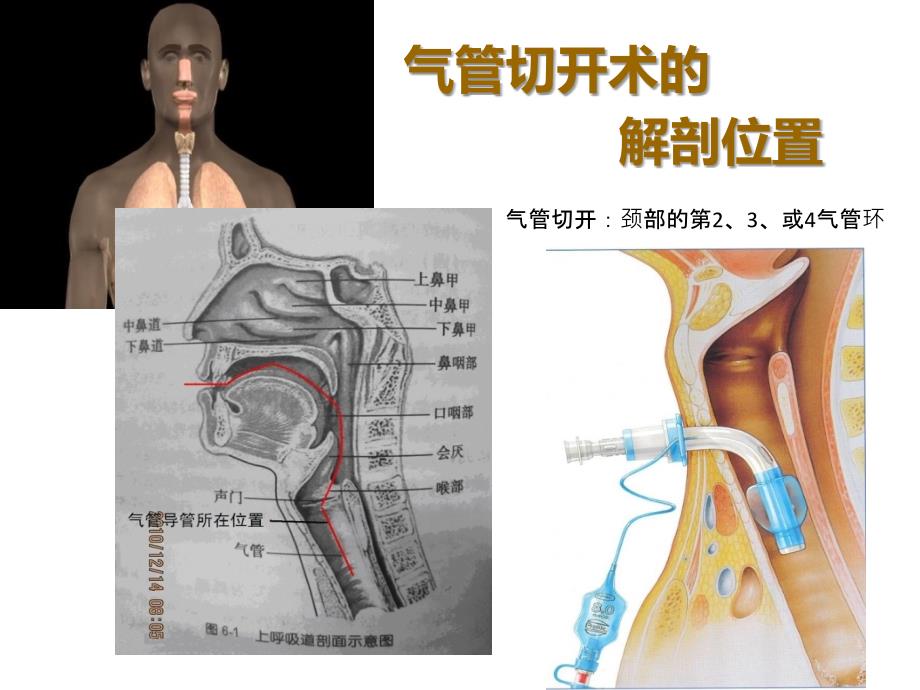 气管切开的护理课件_第4页