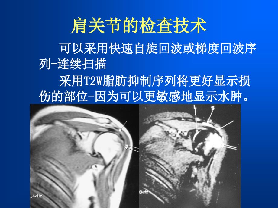 最新肩袖损伤MRI诊断_第3页