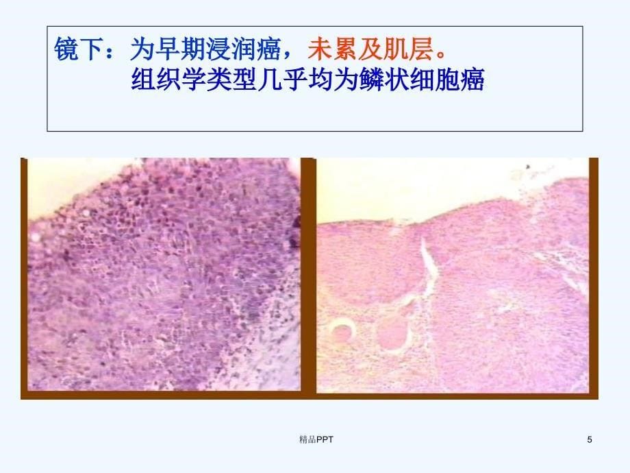 消化系统常见肿瘤医学专业课件_第5页