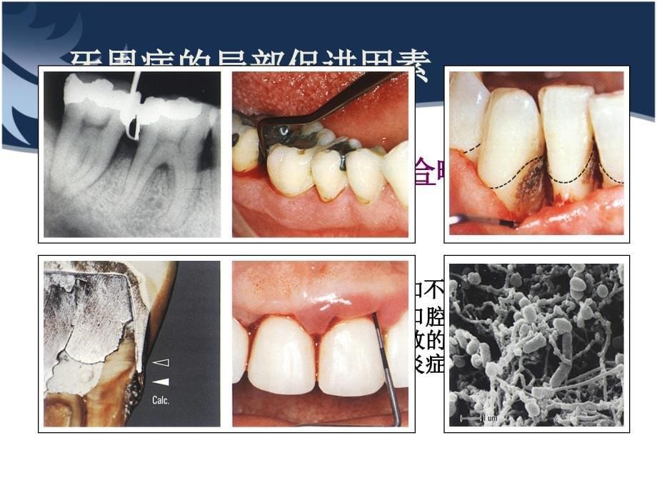 牙周病的局部及全身促进因素_第5页