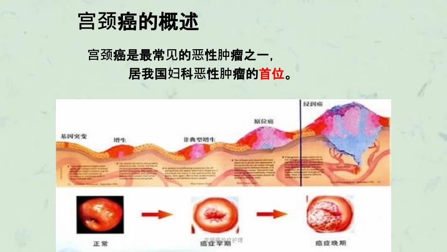 宫颈癌放疗护理课件_第4页