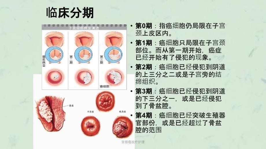 宫颈癌放疗护理课件_第5页