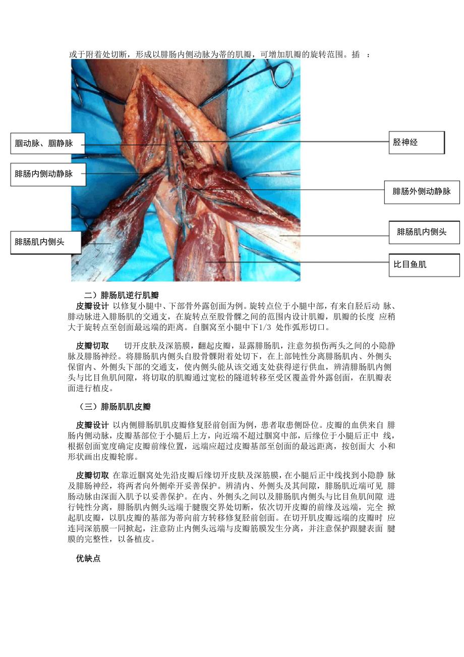 小腿腓肠肌肌皮瓣移植技术_第2页