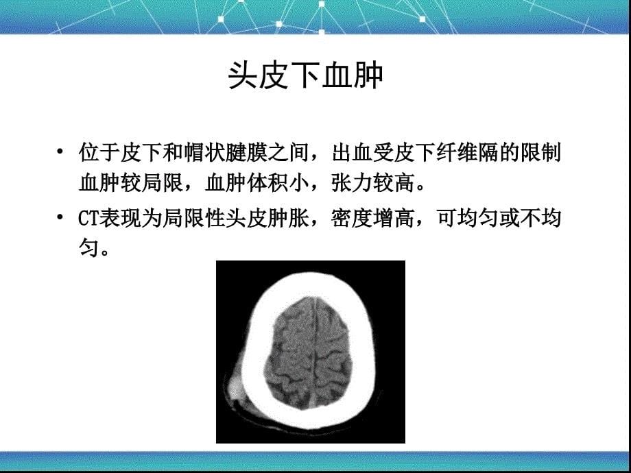 颅脑外伤影像学诊断.ppt_第5页