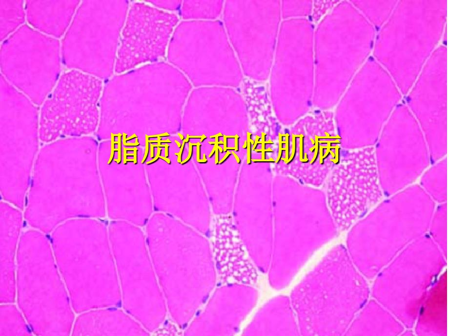 脂质沉积性肌病_第1页
