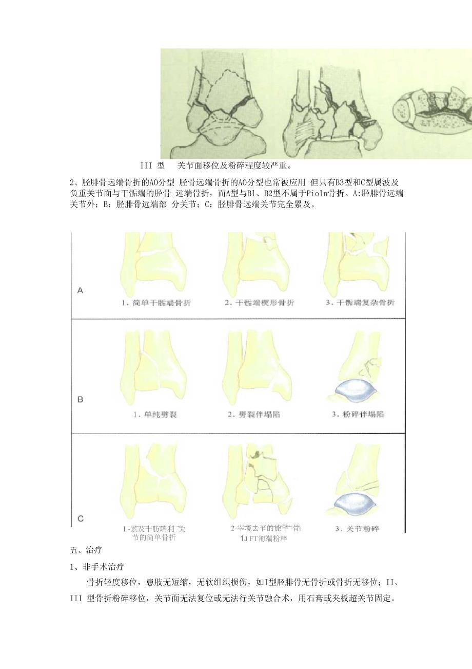 胫腓骨远端骨折_第3页