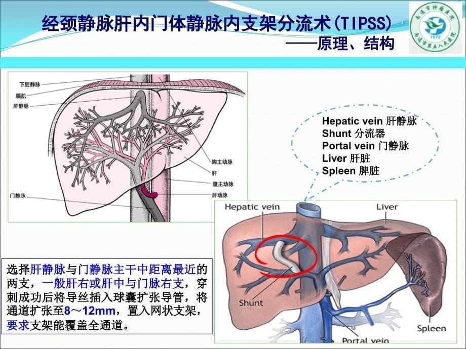 经颈静脉肝内门体分流术(TIPS)_第5页