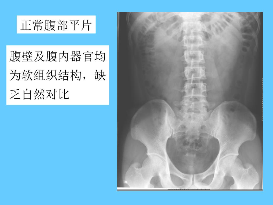 肠梗阻的X线表现_第3页