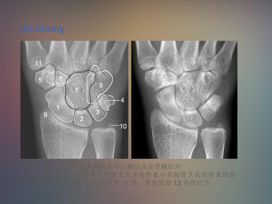 腕关节x线解剖测量分析 ppt课件_第3页