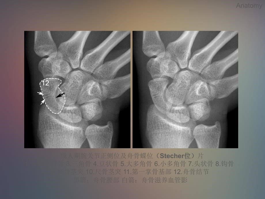 腕关节x线解剖测量分析 ppt课件_第5页