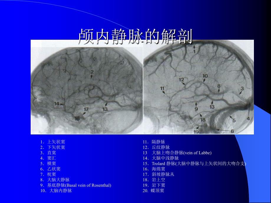 颅内静脉窦血栓形成_第4页