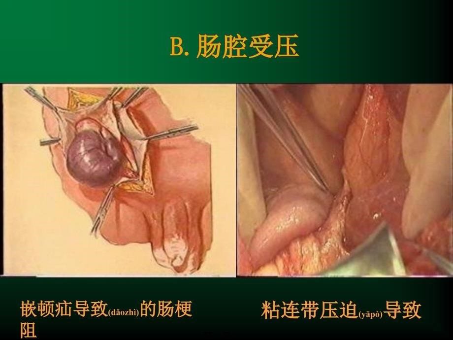 医学专题—肠梗阻11527_第5页