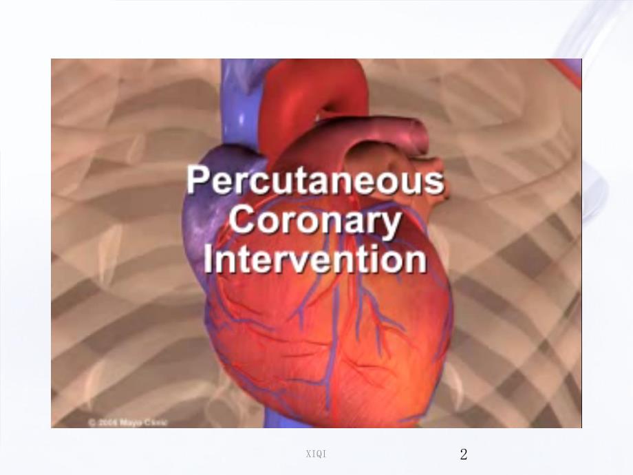 冠脉介入器械最全_第2页