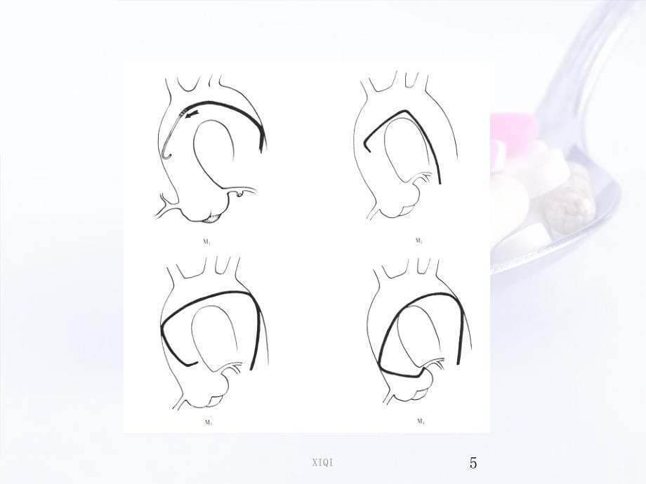 冠脉介入器械最全_第5页