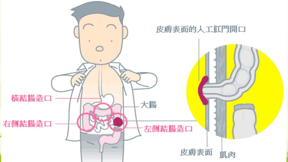 《人工肛门的护理》PPT课件_第4页