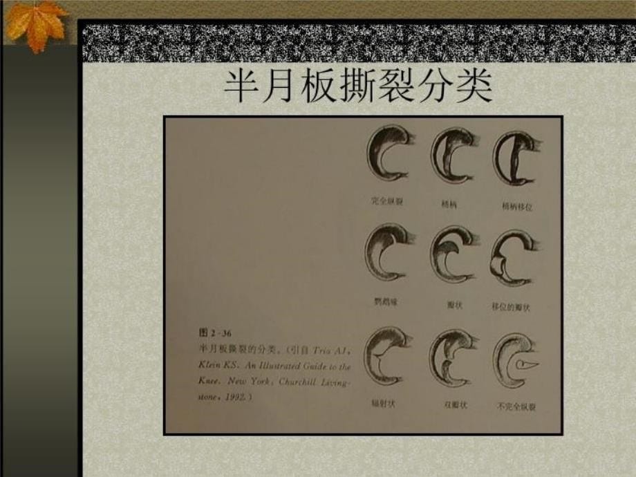 最新半月板损伤的MR表现PPT课件_第5页