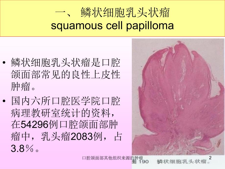 口腔颌面部其他组织来源的肿瘤课件_第2页