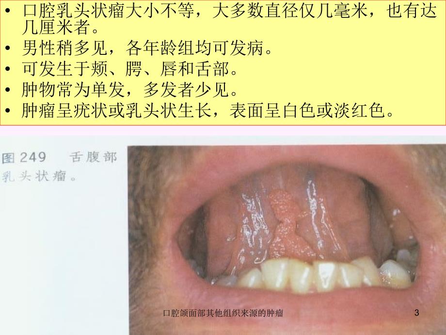 口腔颌面部其他组织来源的肿瘤课件_第3页