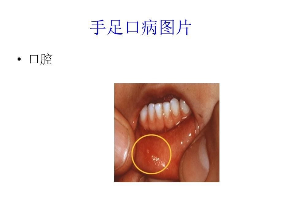 手足口病防治汇总_第5页