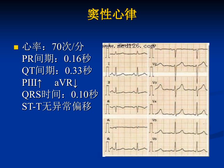 病理心电图表现_第3页